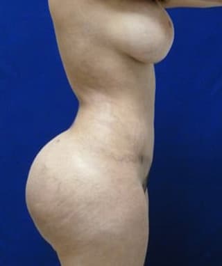 Brazilian Butt Lift after, case 1022, side view (Female, 24: BBL (900 cc per side))