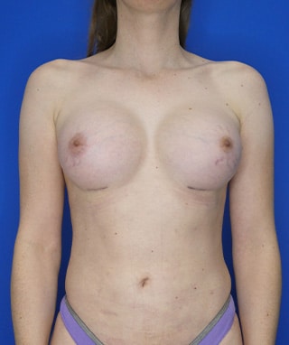 Breast Augmentation after, case 1211, front view