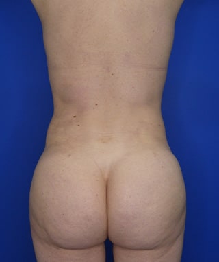 Brazilian Butt Lift after, case 1001, back view (Transgender woman, 33: BBL (500 cc per side) + Breast augmentation (560 / 520 cc))