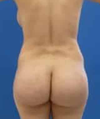 Brazilian Butt Lift before, case 1022, back view (Female, 24: BBL (900 cc per side))