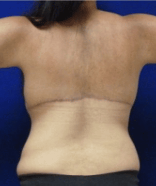 Back Lift after, case 1207, back view (Female, 29: Back lift)
