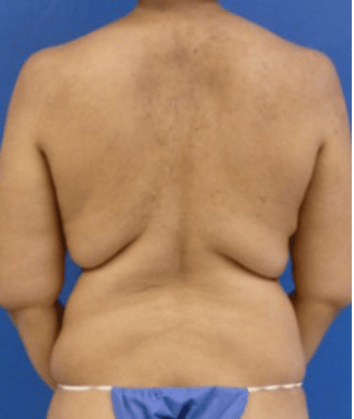 Back Lift before, case 1207, back view (Female, 29: Back lift)