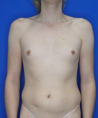 Breast Augmentation before, case 1211, front view
