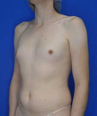 Breast Augmentation before, case 1211, angle view