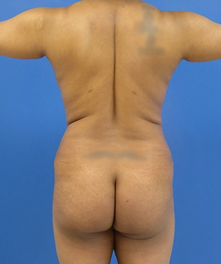 Brazilian Butt Lift before, case 1093, front view (Female, 51: BBL (1,000 cc per side))
