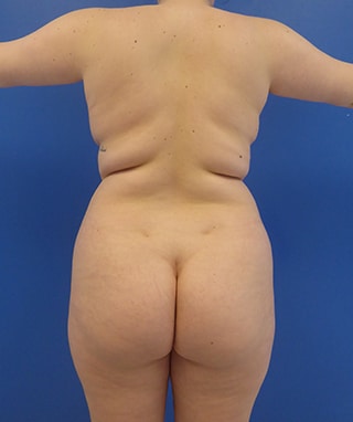 Brazilian Butt Lift before, case 1083, back view (Female, 20: BBL (1,650 cc per side))