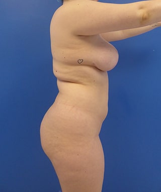 Brazilian Butt Lift before, case 1083, side view (Female, 20: BBL (1,650 cc per side))