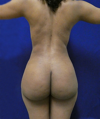 Brazilian Butt Lift after, case 1081, front view (Female, 28: BBL (1,450 cc per side))