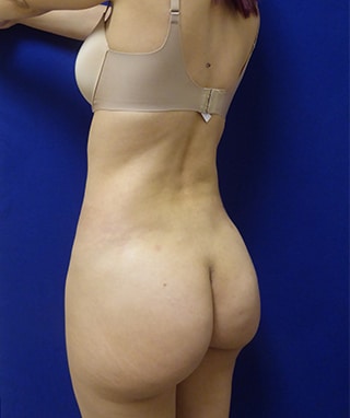 Brazilian Butt Lift after, case 1080, oblique view (Female, 34: BBL (975 cc per side))