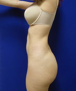 Brazilian Butt Lift after, case 1080, side view (Female, 34: BBL (975 cc per side))