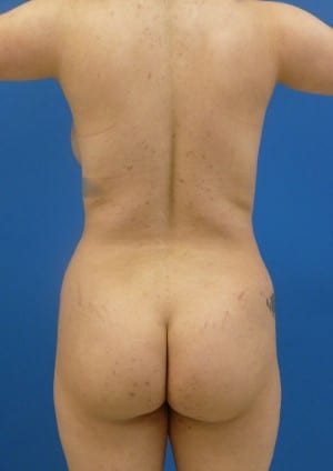 Brazilian Butt Lift before, case 1079, back view (Female, 24: BBL (1,300 cc per side))
