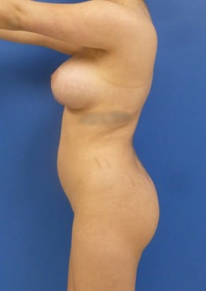 Brazilian Butt Lift before, case 1079, side view (Female, 24: BBL (1,300 cc per side))