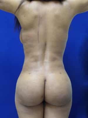 Brazilian Butt Lift after, case 1077, back view (Female, 42: BBL (900 cc per side))