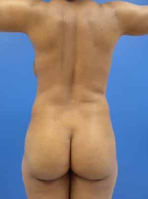 Brazilian Butt Lift before, case 1077, back view (Female, 42: BBL (900 cc per side))