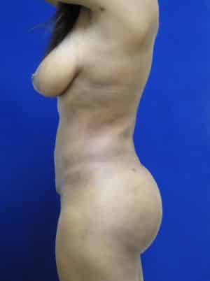 Brazilian Butt Lift after, case 1077, side view (Female, 42: BBL (900 cc per side))
