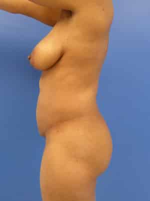Brazilian Butt Lift before, case 1077, side view (Female, 42: BBL (900 cc per side))