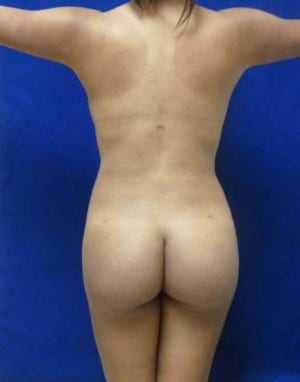 Brazilian Butt Lift after, case 1076, back view (Female, 26: BBL (900 cc per side))
