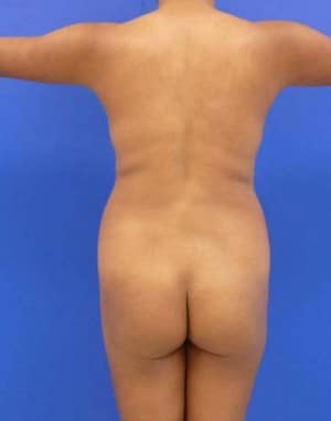 Brazilian Butt Lift before, case 1076, back view (Female, 26: BBL (900 cc per side))