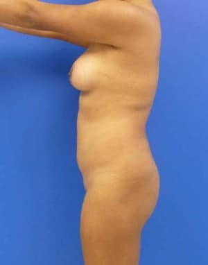 Brazilian Butt Lift before, case 1076, side view (Female, 26: BBL (900 cc per side))