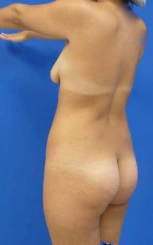 Brazilian Butt Lift before, case 1075, angle view (Female, 30: BBL (1,300 cc per side))