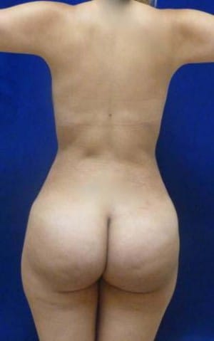 Brazilian Butt Lift after, case 1075, back view (Female, 30: BBL (1,300 cc per side))