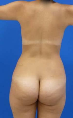 Brazilian Butt Lift before, case 1075, back view (Female, 30: BBL (1,300 cc per side))