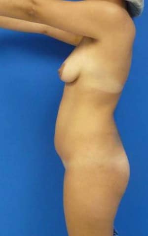 Brazilian Butt Lift before, case 1075, side view (Female, 30: BBL (1,300 cc per side))