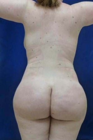 Brazilian Butt Lift after, case 1074, back view (Female, 23: BBL (1,200 cc per side))