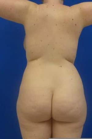 Brazilian Butt Lift before, case 1074, back view (Female, 23: BBL (1,200 cc per side))