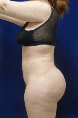 Brazilian Butt Lift after, case 1074, side view (Female, 23: BBL (1,200 cc per side))