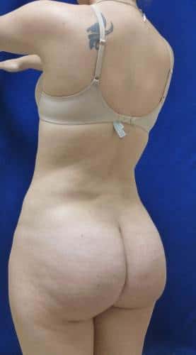 Brazilian Butt Lift after, case 1073, angle view (Female, 20: BBL (1,300 cc per side))