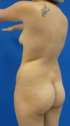 Brazilian Butt Lift before, case 1073, angle view (Female, 20: BBL (1,300 cc per side))