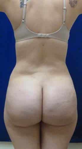 Brazilian Butt Lift after, case 1073, back view (Female, 20: BBL (1,300 cc per side))