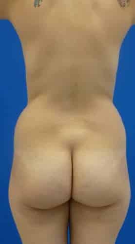 Brazilian Butt Lift before, case 1073, back view (Female, 20: BBL (1,300 cc per side))