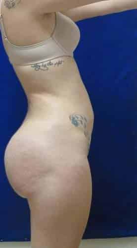 Brazilian Butt Lift after, case 1073, side view (Female, 20: BBL (1,300 cc per side))