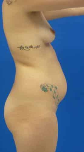 Brazilian Butt Lift before, case 1073, side view (Female, 20: BBL (1,300 cc per side))