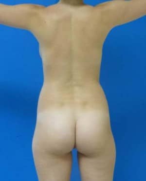 Brazilian Butt Lift before, case 1072, back view (Female, 21: BBL (600 cc per side))