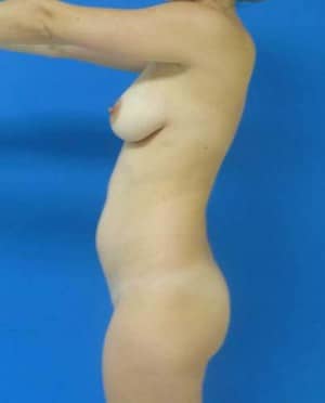 Brazilian Butt Lift before, case 1072, side view (Female, 21: BBL (600 cc per side))