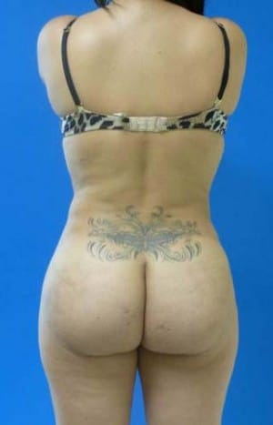 Brazilian Butt Lift after, case 1071, back view (Female, 20: BBL (500 cc per side))