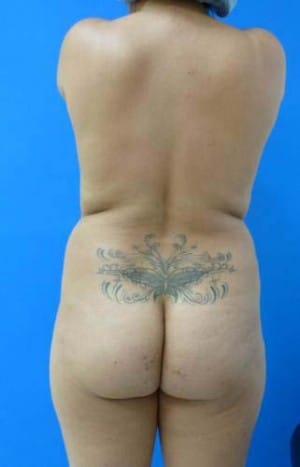 Brazilian Butt Lift before, case 1071, back view (Female, 20: BBL (500 cc per side))