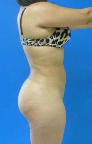 Brazilian Butt Lift after, case 1071, side view (Female, 20: BBL (500 cc per side))