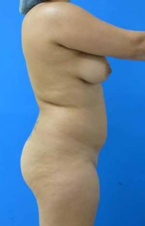 Brazilian Butt Lift before, case 1071, side view (Female, 20: BBL (500 cc per side))