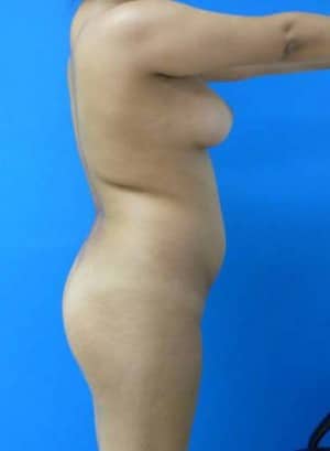 Brazilian Butt Lift before, case 1070, side view (Female, 25: BBL (600 cc per side))