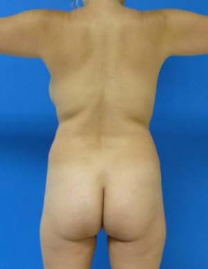 Brazilian Butt Lift before, case 1068, back view (Female, 35: BBL (600 cc per side))