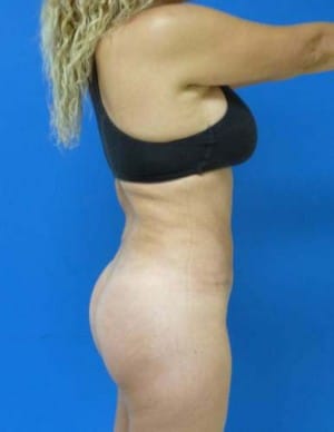 Brazilian Butt Lift after, case 1068, side view (Female, 35: BBL (600 cc per side))