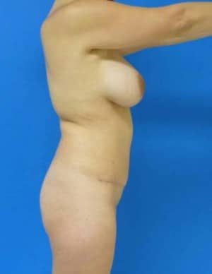 Brazilian Butt Lift before, case 1068, side view (Female, 35: BBL (600 cc per side))