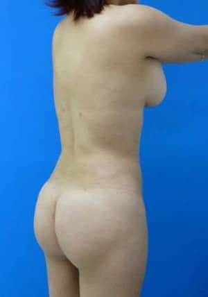 Brazilian Butt Lift after, case 1069, angle view (Female, 35: BBL (700 cc per side))