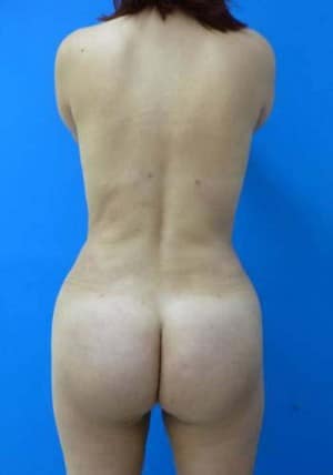 Brazilian Butt Lift after, case 1069, back view (Female, 35: BBL (700 cc per side))