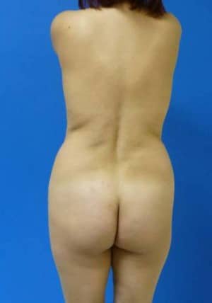 Brazilian Butt Lift before, case 1069, back view (Female, 35: BBL (700 cc per side))