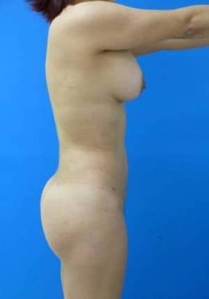 Brazilian Butt Lift after, case 1069, side view (Female, 35: BBL (700 cc per side))
